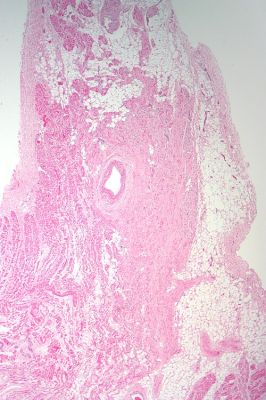 Heart: sinoatrial node - histology slide
This image shows a histology slide of the heart and the SA node.

Image by [url=https://commons.wikimedia.org/wiki/User:Nephron]Nephron[/url], via Wikimedia Commons.

Original file source: [url=https://commons.wikimedia.org/wiki/File:Sinoatrial_node_low_mag.jpg]https://commons.wikimedia.org/wiki/File:Sinoatrial_node_low_mag.jpg[/url]

Title: "Sinoatrial node low mag.jpg"

No changes were made to the original image downloaded (note: this version was downloaded at reduced resolution from Wikimedia Commons).

This file is licensed under the Creative Commons Attribution-Share Alike 3.0 Unported License [url=https://creativecommons.org/licenses/by-sa/3.0/deed.en]https://creativecommons.org/licenses/by-sa/3.0/deed.en[/url].

Copyright © 2013 Michael Bonert, MD, FRCPC ([url=https://commons.wikimedia.org/wiki/User:Nephron]https://commons.wikimedia.org/wiki/User:Nephron[/url] / [url=https://experts.mcmaster.ca/display/bonertm]https://experts.mcmaster.ca/display/bonertm[/url])

You are free to share and adapt this image as per the CC BY-SA 3.0 ([url=https://creativecommons.org/licenses/by-sa/3.0/legalcode]https://creativecommons.org/licenses/by-sa/3.0/legalcode[/url])


Keywords: Heart: sinoatrial node - histology slide