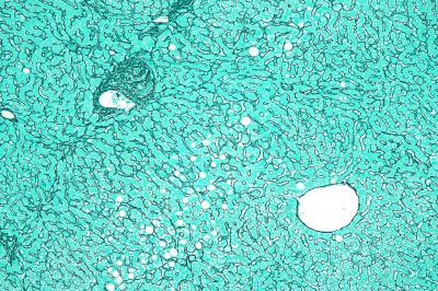 Reticulin stain - histology slide
Micrograph of the liver showing a portal tract and a nearby hepatic venule. Reticulin stain. The normal "hepatocyte plate" -- the strands of hepatocytes that characterise the morphology of the liver and are separated by the liver sinusoids -- is one or two cells thick, as shown in the image. (Description text from the Wikimedia Commons file page.) 

Image by [url=https://commons.wikimedia.org/wiki/User:Nephron]Nephron[/url], via Wikimedia Commons.

Original file source: [url=https://commons.wikimedia.org/wiki/File:Liver_reticulin.jpg]https://commons.wikimedia.org/wiki/File:Liver_reticulin.jpg [/url]

Title: "Liver_reticulin.jpg"

No changes were made to the original image downloaded (note: this version was downloaded at reduced resolution from Wikimedia Commons).

This file is licensed under the Creative Commons Attribution-Share Alike 3.0 Unported License [url=https://creativecommons.org/licenses/by-sa/3.0/deed.en]https://creativecommons.org/licenses/by-sa/3.0/deed.en[/url].

Copyright © 2009 Michael Bonert, MD, FRCPC ([url=https://commons.wikimedia.org/wiki/User:Nephron]https://commons.wikimedia.org/wiki/User:Nephron[/url] / [url=https://experts.mcmaster.ca/display/bonertm]https://experts.mcmaster.ca/display/bonertm[/url])

You are free to share and adapt this image as per the CC BY-SA 3.0 ([url=https://creativecommons.org/licenses/by-sa/3.0/legalcode]https://creativecommons.org/licenses/by-sa/3.0/legalcode[/url])

Keywords: Reticulin stain - histology slide