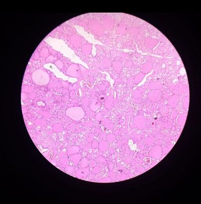 Thyroid gland - histology slide
This is a histology slide of the thyroid gland.

Histology slide courtesy of Bhavya akula and Wikimedia Commons. No changes were made from the download.

This file is licensed under the  Creative Commons Attribution-Share Alike 4.0 International license (https://creativecommons.org/licenses/by-sa/4.0/deed.en).

