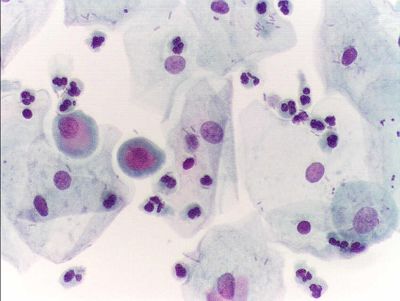 Cells - urine cytology
Normal urine cytology, Papanicolau stain, 400x. No atypical cell can be seen. (Description text from the Wikimedia Commons file page.)

Source: Slide files from Hospital of Monfalcone (Italy)
Author:  Alex_brollo, via Wikimedia Commons. 

Original file source: [url=https://commons.wikimedia.org/wiki/File:Urine_normal_cytology.JPG]https://commons.wikimedia.org/wiki/File:Urine_normal_cytology.JPG[/url]

Title: "Urine_normal_cytology.JPG"

No changes were made to the original image downloaded.  

Permission is granted to copy, distribute and/or modify this document under the terms of the GNU Free Documentation License, Version 1.2 or any later version published by the Free Software Foundation; with no Invariant Sections, no Front-Cover Texts, and no Back-Cover Texts. A copy of the license is included in the section entitled GNU Free Documentation License. [url=https://commons.wikimedia.org/wiki/Commons:GNU_Free_Documentation_License,_version_1.2]https://commons.wikimedia.org/wiki/Commons:GNU_Free_Documentation_License,_version_1.2[/url]

This file is licensed under the Creative Commons Attribution-Share Alike 3.0 Unported license. [url=https://creativecommons.org/licenses/by-sa/3.0/deed.en/]https://creativecommons.org/licenses/by-sa/3.0/deed.en/[/url]
Keywords: kidney