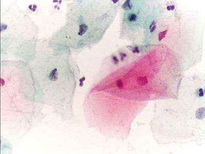 Papanicolau stain - cytology
Pap test, Papanicolau stain, 400x. Normal squamous epithelial cells in a premenopausal women. (Description text from the Wikimedia Commons file page.)

Source: Slide files from Hospital of Mionfalcone (Italy)
Author:  Alex_brollo, via Wikimedia Commons. 

Original file source: [url=https://commons.wikimedia.org/wiki/File:Pap_test_normal.jpg] https://commons.wikimedia.org/wiki/File:Pap_test_normal.jpg[/url]

Title: "Pap test normal.jpg"

No changes were made to the original image downloaded.  

Permission is granted to copy, distribute and/or modify this document under the terms of the GNU Free Documentation License, Version 1.2 or any later version published by the Free Software Foundation; with no Invariant Sections, no Front-Cover Texts, and no Back-Cover Texts. A copy of the license is included in the section entitled GNU Free Documentation License. [url=https://commons.wikimedia.org/wiki/Commons:GNU_Free_Documentation_License,_version_1.2]https://commons.wikimedia.org/wiki/Commons:GNU_Free_Documentation_License,_version_1.2[/url]

This file is licensed under the Creative Commons Attribution-Share Alike 3.0 Unported license. [url=https://creativecommons.org/licenses/by-sa/3.0/deed.en/]https://creativecommons.org/licenses/by-sa/3.0/deed.en/[/url]

